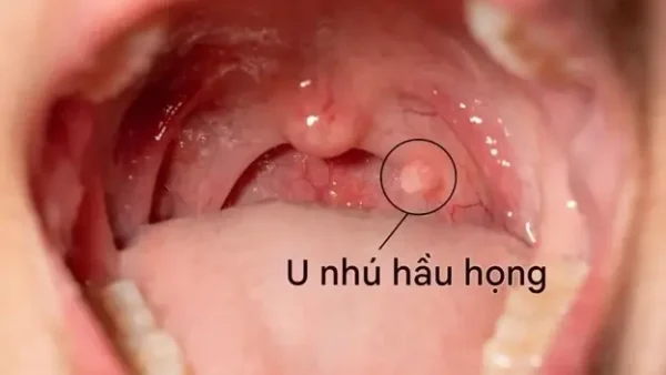 Vi Khuẩn HP Là Gì? Nguyên Nhân, Triệu Chứng, Lây Nhiễm Và Cách Phòng Tránh