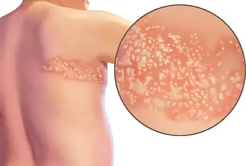 Bệnh Whitmore (melioidosis): Nguyên Nhân, Triệu Chứng Và Cách Phòng Ngừa Hiệu Quả