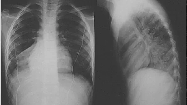 Xẹp Phổi Là Gì? Nguyên Nhân, Triệu Chứng Và Cách Điều Trị Hiệu Quả