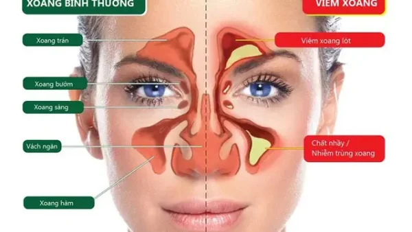 Viêm Xoang Là Gì? Nguyên Nhân, Triệu Chứng, Chẩn Đoán Và Cách Điều Trị Hiệu Quả