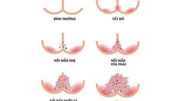Bị Hăm Là Gì? Nguyên Nhân, Dấu Hiệu Và Cách Xử Lý Hiệu Quả