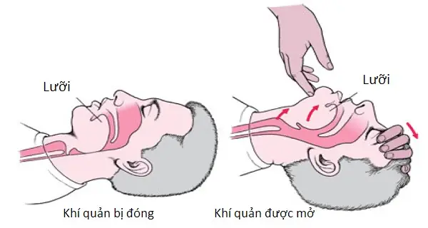 "nuốt Lưỡi" Là Gì? Nguyên Nhân, Dấu Hiệu Và Cách Sơ Cứu Đúng Cách
