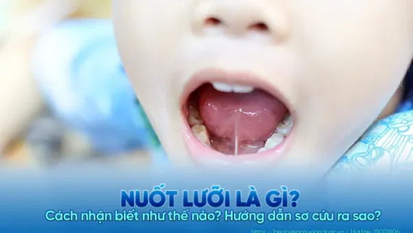 “nuốt Lưỡi” Là Gì? Nguyên Nhân, Dấu Hiệu Và Cách Sơ Cứu Đúng Cách