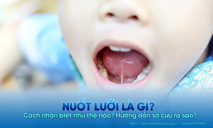 "nuốt Lưỡi" Là Gì? Nguyên Nhân, Dấu Hiệu Và Cách Sơ Cứu Đúng Cách