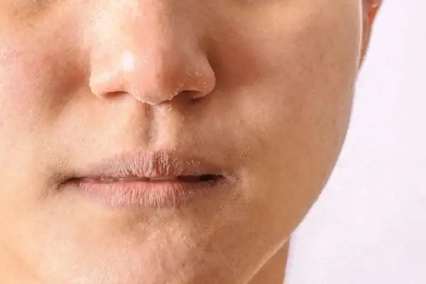 Bị Phể Da Mặt Là Gì? Nguyên Nhân, Triệu Chứng Và Cách Khắc Phục Hiệu Quả