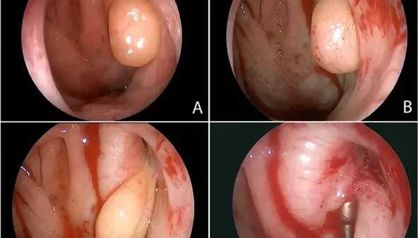 Viêm Tai Giữa Là Gì? Nguyên Nhân, Triệu Chứng Và Cách Điều Trị Hiệu Quả
