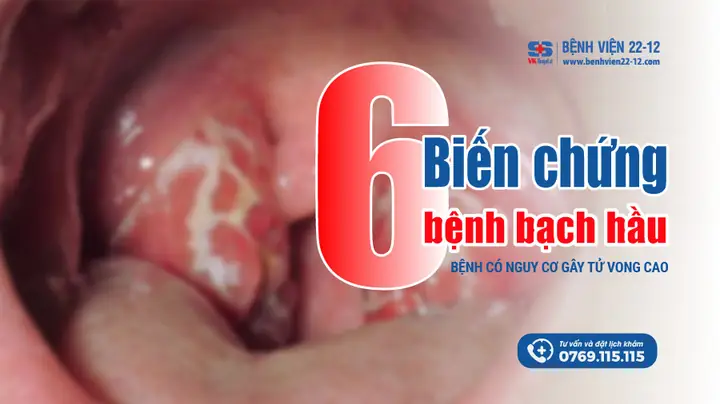 Biến Chứng Nguy Hiểm Của Bệnh Bạch Hầu: Các Dấu Hiệu Cần Nhận Biết Sớm