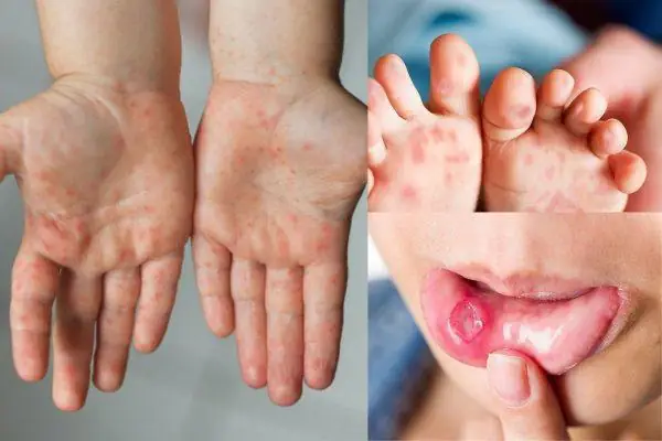 Biểu Hiện Bệnh Tay Chân Miệng Ở Trẻ: Nhận Biết Dấu Hiệu Sớm Và Giai Đoạn Bệnh