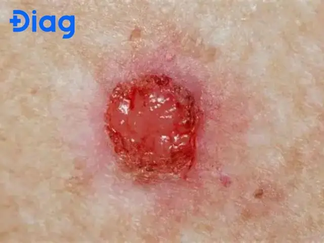 Biểu Mô Vảy Là Gì? Phân Biệt Các Loại Và Tầm Quan Trọng Trong Chẩn Đoán
