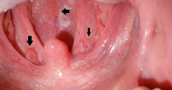 Biểu Mô Vảy Là Gì? Phân Biệt Các Loại Và Tầm Quan Trọng Trong Chẩn Đoán