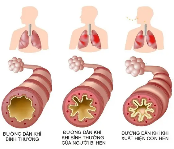 Bình Suyễn Là Gì? Hiểu Rõ Tình Trạng Hen Suyễn Và Các Phương Pháp Hỗ Trợ Điều Trị