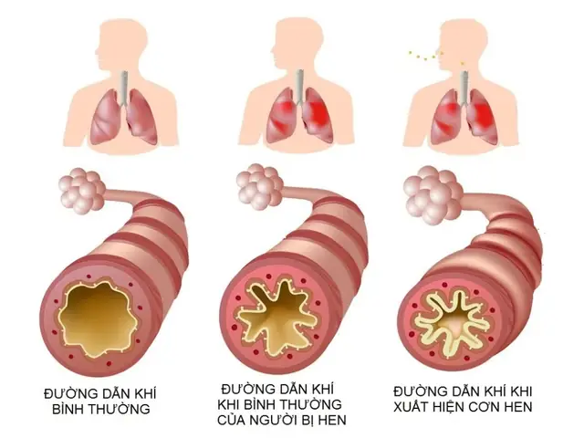 Bình Suyễn Là Gì? Hiểu Rõ Tình Trạng Hen Suyễn Và Các Phương Pháp Hỗ Trợ Điều Trị