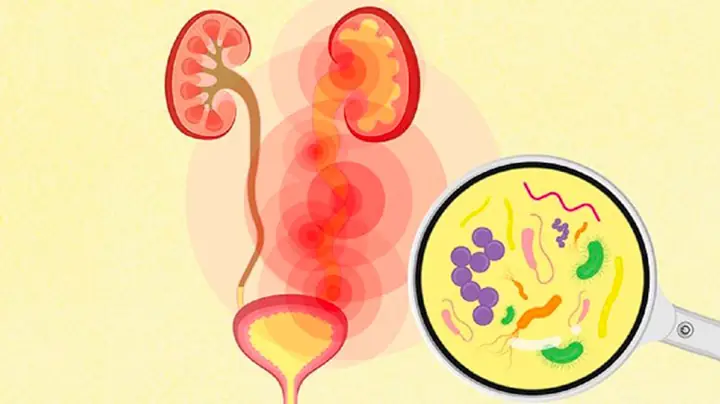 Viêm Đường Tiết Niệu Là Gì? Nguyên Nhân, Triệu Chứng & Cách Phòng Ngừa Hiệu Quả