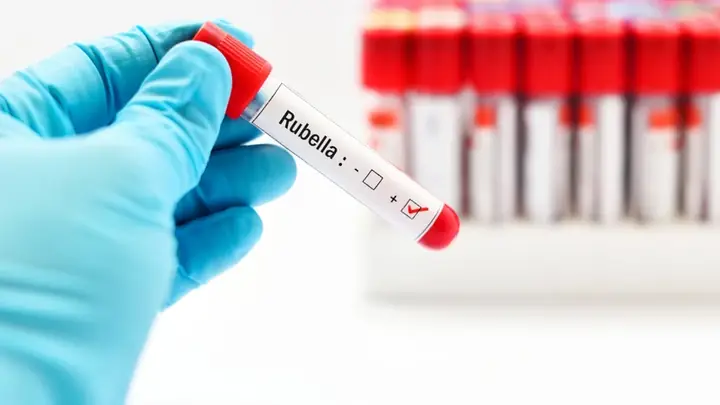 Blood Pos Là Gì? Ý Nghĩa Chỉ Số BLD (blood) Trong Xét Nghiệm Nước Tiểu