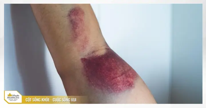 Blunt Trauma Là Gì? Định Nghĩa, Nguyên Nhân Và Các Loại Chấn Thương Phổ Biến