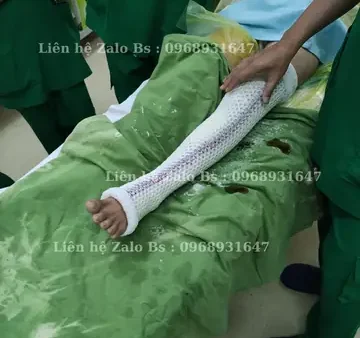Bó Bột Thủy Tinh Là Gì? Ưu Điểm, So Sánh Và Cách Sử Dụng