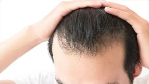 Tóc Bò Liếm Là Gì? Nguyên Nhân & Cách Khắc Phục Hiệu Quả Cho Nam Nữ