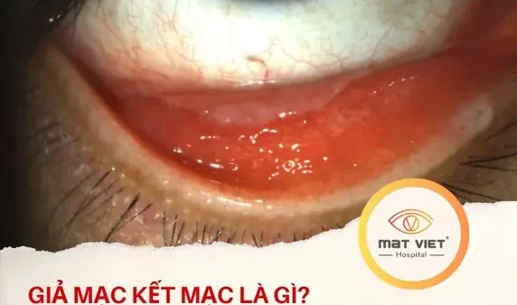 Bóc Giả Mạc Mắt Là Gì? Nguyên Nhân, Quy Trình Và Cách Chăm Sóc Sau Điều Trị