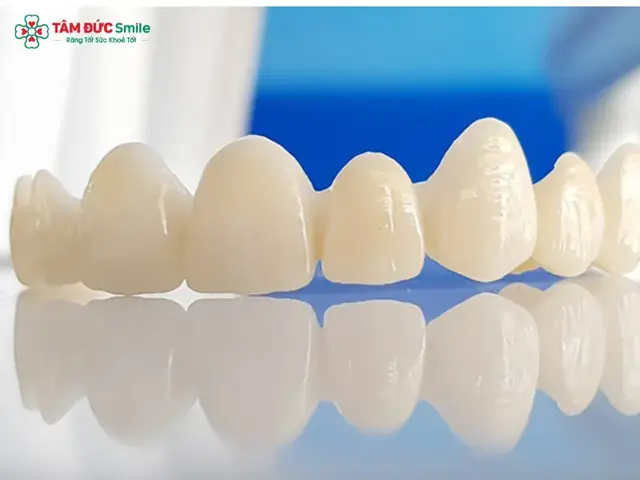 Răng Sứ Cercon Là Gì? Ưu Điểm, Phân Loại & Chi Phí Bọc Răng Sứ Cercon