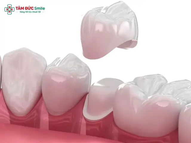 Bọc Răng Sứ Sinh Học Là Gì? Đặc Điểm, Ưu Nhược Điểm & Quy Trình Chi Tiết