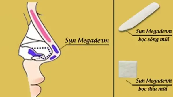 Nâng Mũi Bọc Sụn Megaderm Là Gì? Ưu Điểm, Quy Trình & Lưu Ý