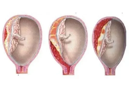 Bóc Tách Cực Dưới Túi Thai: Hiểu Đúng Về Tình Trạng, Dấu Hiệu Và Cách Xử Trí