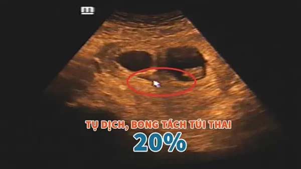 Bóc Tách Túi Thai Là Gì? Nguyên Nhân, Dấu Hiệu Và Cách Xử Trí An Toàn