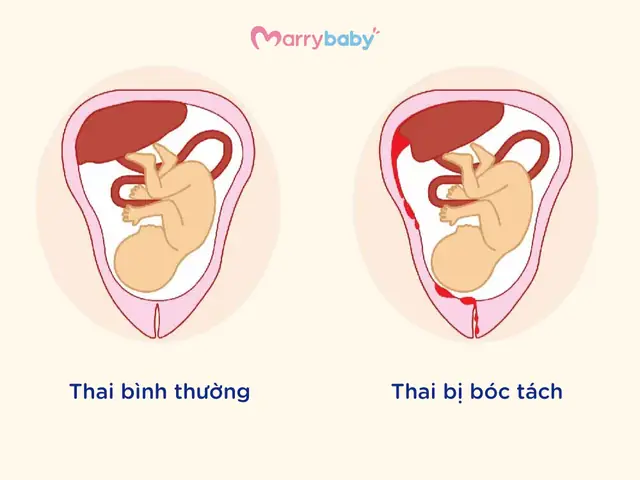 Bóc Tách Túi Thai Là Gì? Nguyên Nhân, Dấu Hiệu Và Cách Xử Trí An Toàn Bóc Tách Túi Thai Là Gì? Nguyên Nhân, Dấu Hiệu Và Cách Xử Trí An Toàn