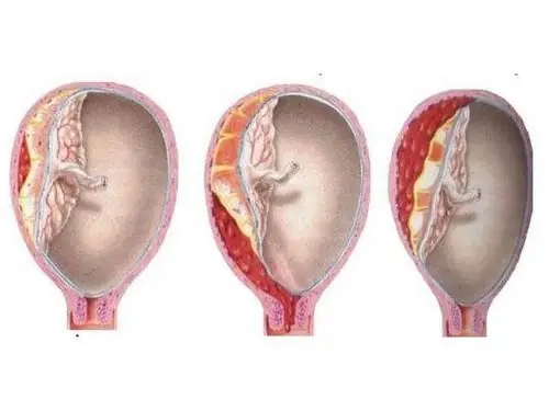 Bóc Tách Túi Thai Là Gì? Nguyên Nhân, Dấu Hiệu Và Cách Xử Trí An Toàn Bóc Tách Túi Thai Là Gì? Nguyên Nhân, Dấu Hiệu Và Cách Xử Trí An Toàn