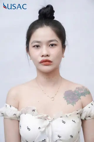 Bone Design Là Gì? Phương Pháp Nắn Xương Thẩm Mỹ Làm Thon Gọn Mặt Hiệu Quả