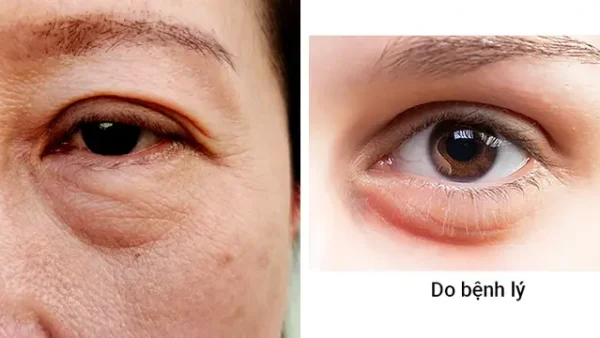 Bọng Là Gì? Phân Biệt Các Loại Bọng & Cách Khắc Phục Hiệu Quả
