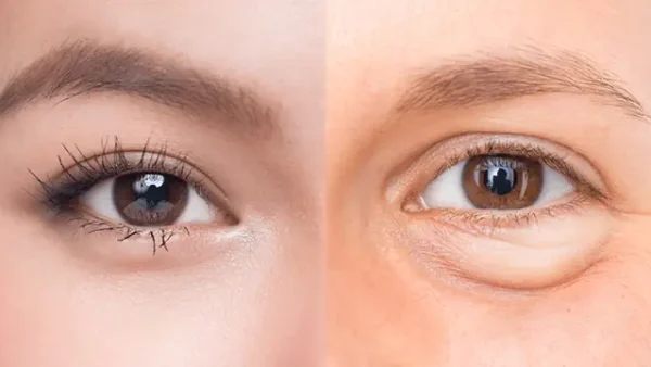 Bọng Mỡ Mắt Là Gì? Nguyên Nhân, Dấu Hiệu & Cách Khắc Phục Hiệu Quả