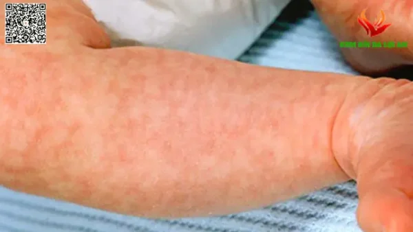 Bông Sữa Là Gì? Dấu Hiệu Nhận Biết, Nguyên Nhân Và Khi Nào Cần Gặp Bác Sĩ