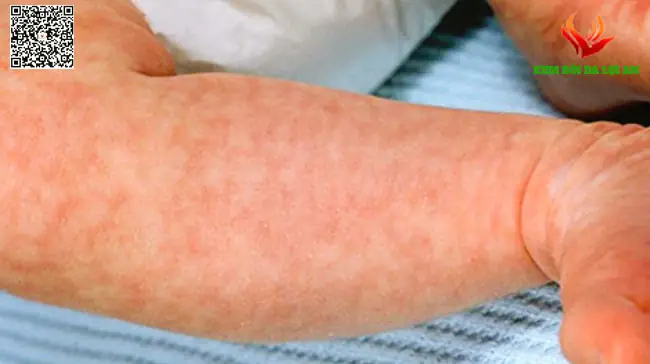 Bông Sữa Là Gì? Dấu Hiệu Nhận Biết, Nguyên Nhân Và Khi Nào Cần Gặp Bác Sĩ