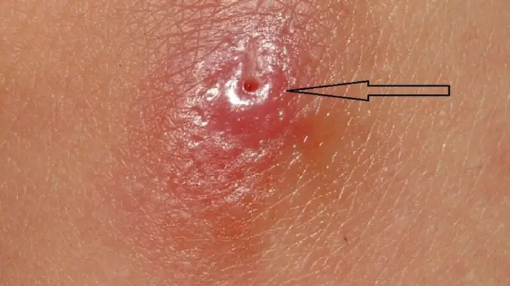 Botfly Maggot Là Gì? Đặc Điểm, Dấu Hiệu Nhiễm Trùng Và Cách Xử Lý