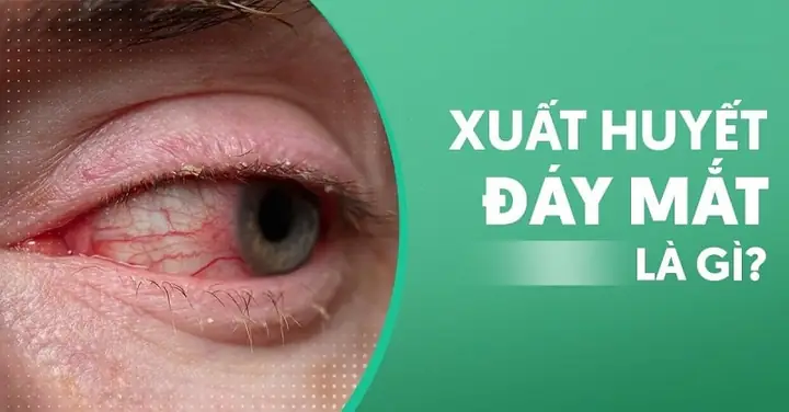 Broccophane Là Gì? Thành Phần, Công Dụng Và Vai Trò Sức Khỏe Broccophane Là Gì? Thành Phần, Công Dụng Và Vai Trò Sức Khỏe