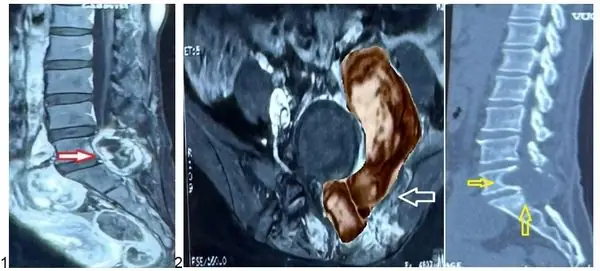 Phồng Đĩa Đệm (bulging Disc) Là Gì? Triệu Chứng, Nguyên Nhân Và Cách Điều Trị Hiệu Quả