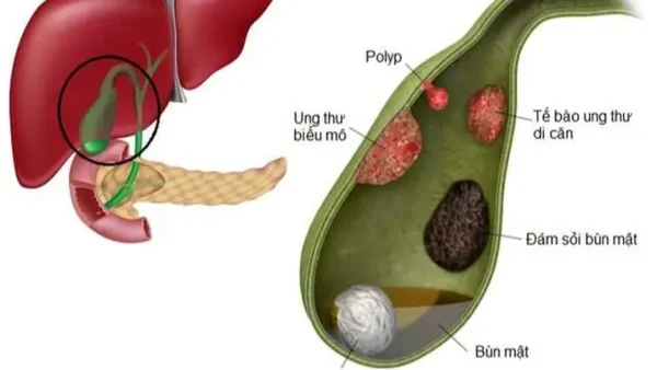 Bùn Túi Mật Là Gì? Nguyên Nhân, Triệu Chứng Và Dấu Hiệu Nhận Biết Sớm