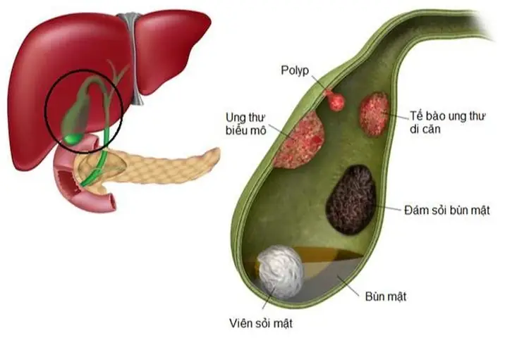 Bùn Túi Mật Là Gì? Nguyên Nhân, Triệu Chứng Và Dấu Hiệu Nhận Biết Sớm