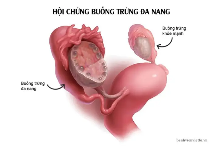 Nang Buồng Trứng Là Gì? Nguyên Nhân, Dấu Hiệu Và Cách Xử Lý