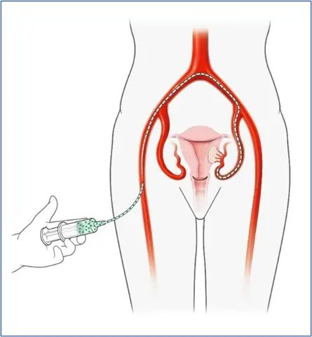 Bướu Gan Là Gì? Phân Biệt Các Loại Bướu Gan Lành Tính Và Ác Tính, Dấu Hiệu Nhận Biết