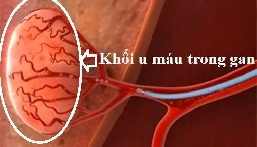 U Máu Gan Là Gì? Dấu Hiệu Nhận Biết, Nguyên Nhân Và Khi Nào Cần Điều Trị
