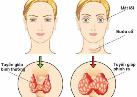 Bướu Parado Là Gì? Nguyên Nhân, Triệu Chứng Và Cách Điều Trị Hiệu Quả