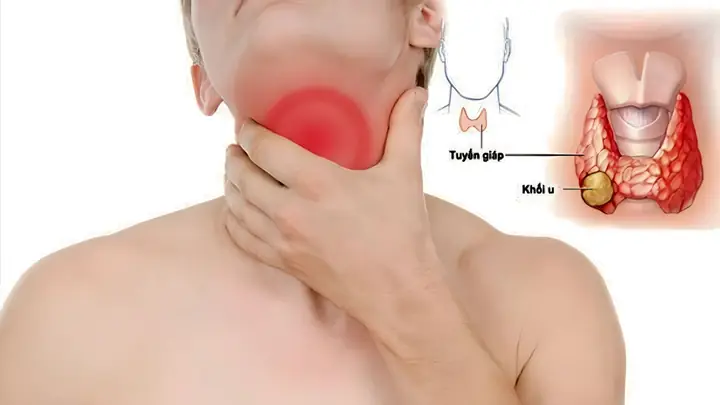 C73 Là Gì? Tìm Hiểu Mã ICD-10 Cho Ung Thư Tuyến Giáp Và Các Thông Tin Liên Quan