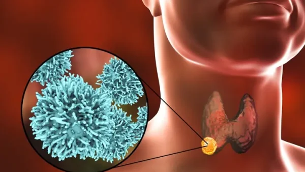 C73 Là Gì? Tìm Hiểu Mã ICD-10 Cho Ung Thư Tuyến Giáp Và Các Thông Tin Liên Quan