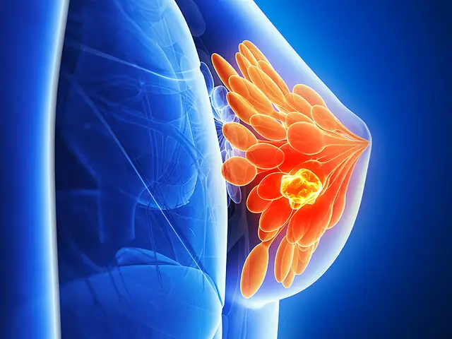 CA 15-3 Là Gì? Chỉ Số Dấu Ấn Ung Thư Vú Và Ý Nghĩa Của Nó