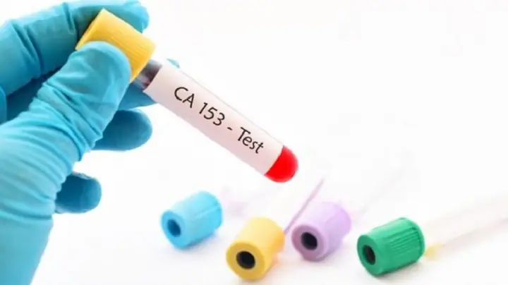 CA 15-3 Là Gì? Chỉ Số Dấu Ấn Ung Thư Vú Và Ý Nghĩa Của Nó