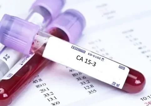 CA 15-3 Là Gì? Giải Đáp Chi Tiết Về Chỉ Số Ung Thư Vú Quan Trọng