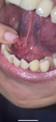 Canker Sore Là Gì? Nguyên Nhân, Triệu Chứng Và Cách Điều Trị Hiệu Quả