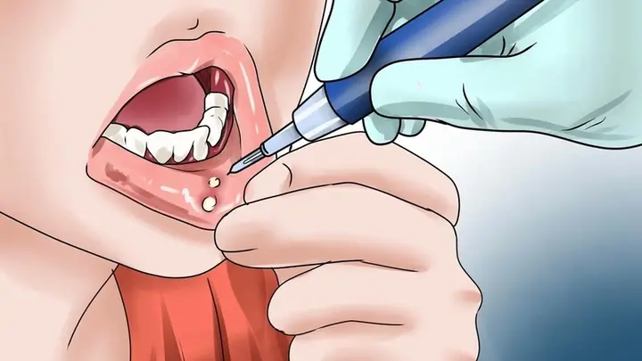 Canker Sore Là Gì? Nguyên Nhân, Triệu Chứng Và Cách Điều Trị Hiệu Quả